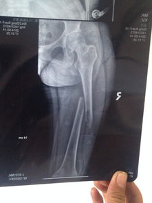 我孩子 大腿骨折 做手术 拍片子 骨头上明显 挖了 医生说 是骨头 被吸收 我该怎么办 去那医院看 搜狗问问 