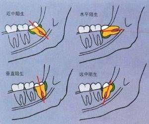 拔智齿会要人命吗 到底有没有危险