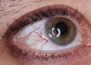 如何消除眼睛内的红血丝(如何消除眼睛内的红血丝图片)