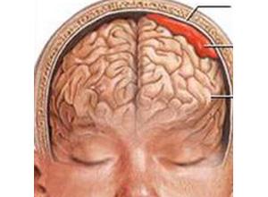 创伤性硬膜下血肿怎么办 