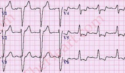 必知的5类心梗心电图,你都掌握了吗