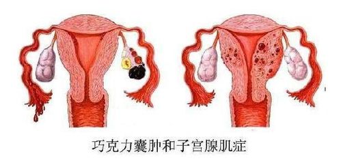 子宫腺肌症合并巧囊该怎么治疗