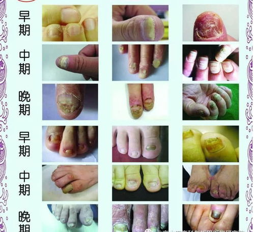 引起灰指甲疾病的原因有哪些