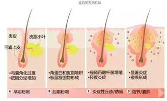 痘痘长不停,春节要来临 怎么办 