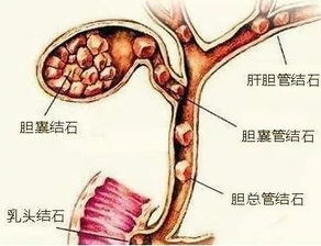 9厘米的胆囊,为啥会长出几百颗结石 伤胆5件事千万别再做