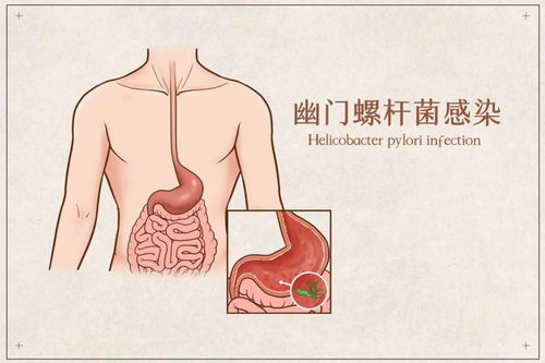 北平说 爸爸查出幽门螺杆菌,家里的小朋友怎么办