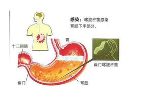 口臭 体臭的人胃几乎都不好,原来是幽门螺杆菌在作怪