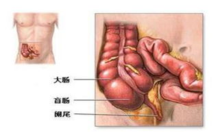 阑尾寄生虫病的症状