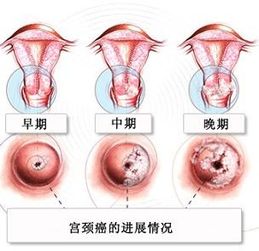 宫颈癌早期症状 宫颈癌前兆是什么