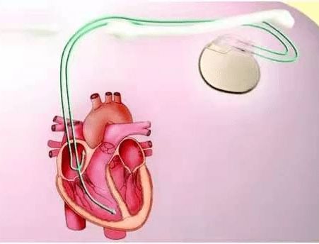 那些常见的心脏介入手术问题盘点