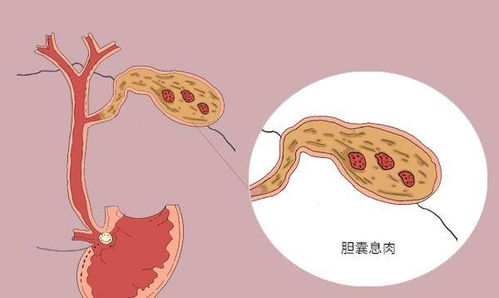 胃息肉 肠息肉 胆囊息肉,哪种癌变几率大 医生跟你说实话