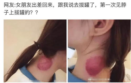 女友出差回来后就去拔罐了,这是为什么 网友 没见过在脖子上拔罐的