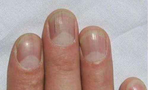 手指甲长出的 3条线 ,可能预示着大病 埋伏 体内,不妨一看