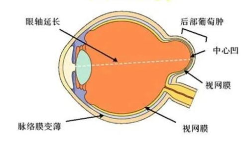 后巩膜加固术是怎样 拯救 高度近视的