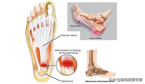 晨起足底疼痛僵硬,爬楼梯更痛,3步缓解