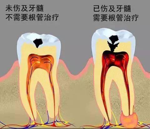 蛀牙不痛更得补