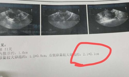 北京不孕不育医院 NT顺利通过 击败多囊,保胎成功