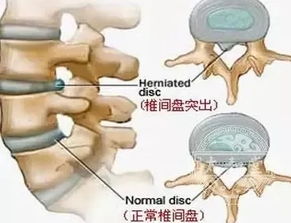 腰间盘突出腿疼是什么原因引起的(腰间盘突出腿疼的症状)