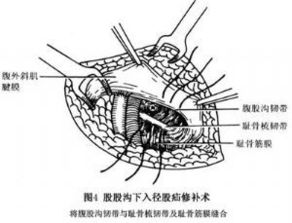 股疝的治疗