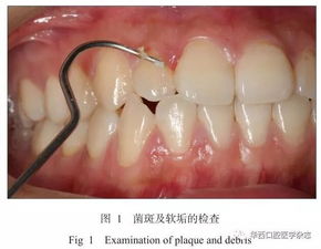 牙周炎患者正畸治疗的时机与顺序是怎样的