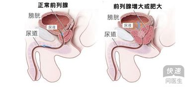 前列腺增生的危害，前列腺增生有什么危害