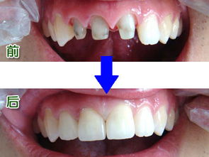 门牙缺损做全瓷牙修复有哪些好处