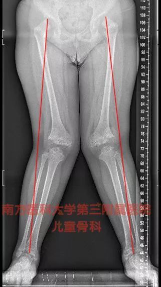 X型腿 O型腿 膝内外翻 的治疗