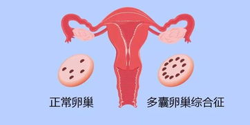 多囊卵巢综合症能怀孕吗(多囊卵巢能自然怀孕吗)