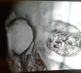 鼻骨塌陷骨折ct图片 搜狗图片搜索