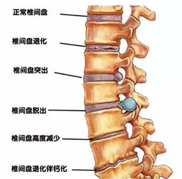 同样是腰椎间盘,为何你如此突出 大咖为你支招