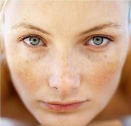女人脸上为什么会长斑 分析女人容易长斑的原因 