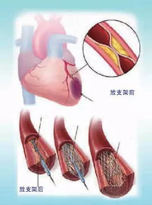 简单几步远离心脏支架