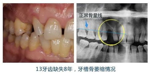 做种植牙植骨是什么呢