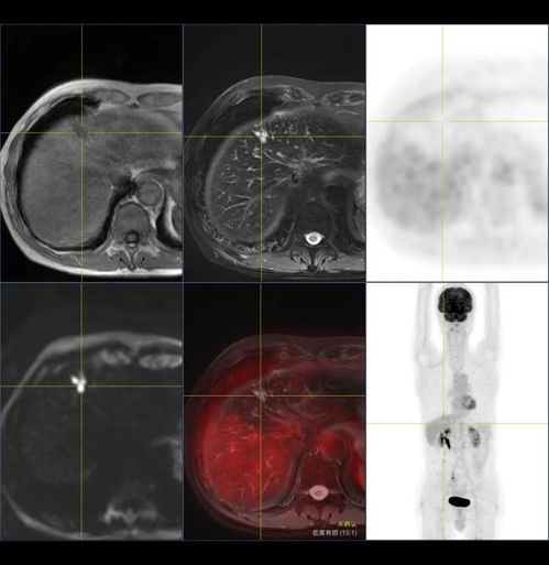 为什么不建议做pet-ct(为什么不建议做微量元素检查)