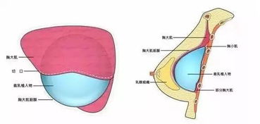 在杭州做的假体隆胸,摸起来是什么感觉