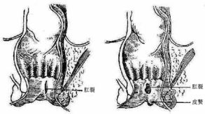 肛裂出血的原因有哪些 肛裂出血怎么办