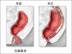 直肠内脱垂怎么治疗(直肠脱垂怎么治疗?)