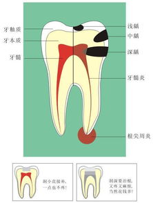 如何保存年轻恒牙的牙髓活力