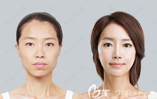韩国ID2019年招募模特招募面部轮廓三件套 双鄂 鼻子 隆胸 抽脂模特开始啦