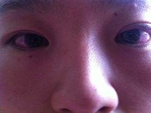 眼白红是什么原因 没有过渡同眼 感觉干涩还痒 每天早上起来的时候眼屎比较多 