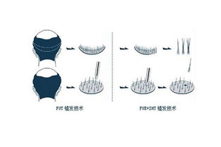 河南毛囊移植研究院，正不正规，有乱收费现象吗