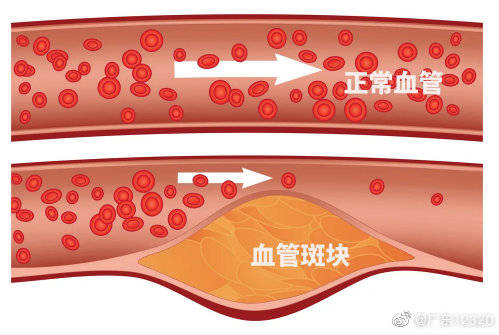 血管堵了,定期输液可以把斑块化掉