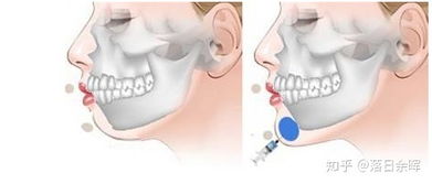 下巴后缩有什么改善的方法 