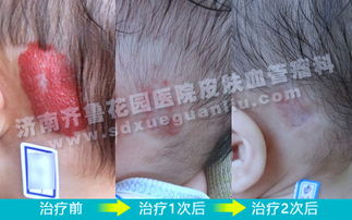 宝宝耳朵后面头皮上的红色疙瘩能治的和没长过一样吗