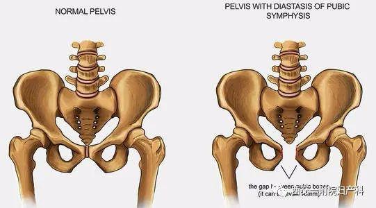 孕期不可承受之痛 耻骨联合分离症 2