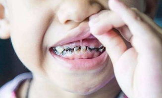4岁宝宝15颗烂牙被拔掉,乳牙不拔出牙也受影响