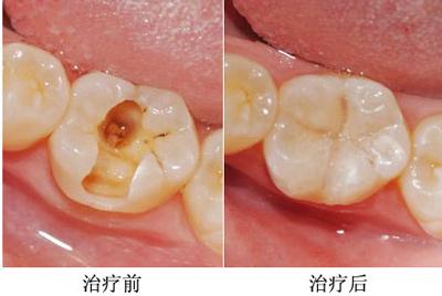 南京补牙洞多少钱 