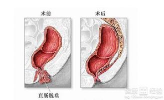 直肠粘膜糜烂性炎症怎样治疗