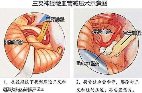 三叉神经痛 原发性和继发性治疗方法不一样