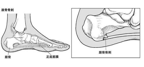 后脚跟疼,是不是长了骨刺 4个方法帮你治疗骨刺